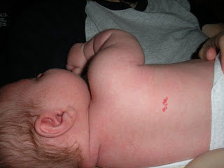 Birthmarks, Blocked Tear Ducts & Colic