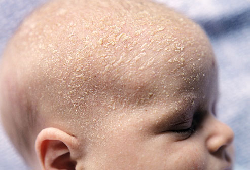 Hair Care (Cradle Cap)