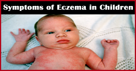 Symptoms of Eczema in Children