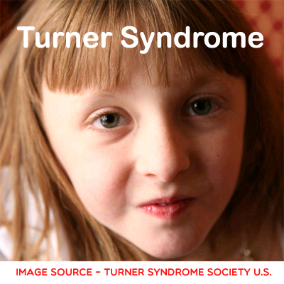 Turner Syndrome: Causes, Symptoms and Treatment