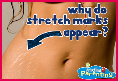 Causes of Stretch Marks