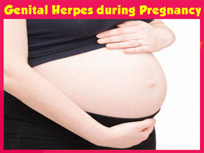 Genital Herpes during Pregnancy