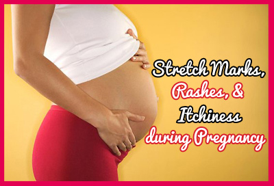 Stretch Marks Rash And Itchiness India Parenting