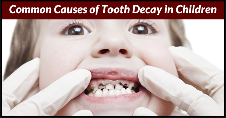 Common Causes of Tooth Decay in Children