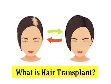 What is Hair Transplant? What is Hair Transplant?