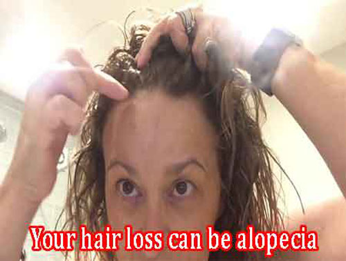 Your hair loss can be alopecia Your hair loss can be alopecia