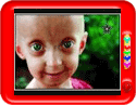 Progeria Images
