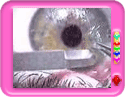 Lasik Operation Gone Wrong