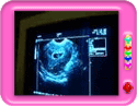 Ultrasound after IVF